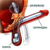 Двухцилиндровый фаллопротез